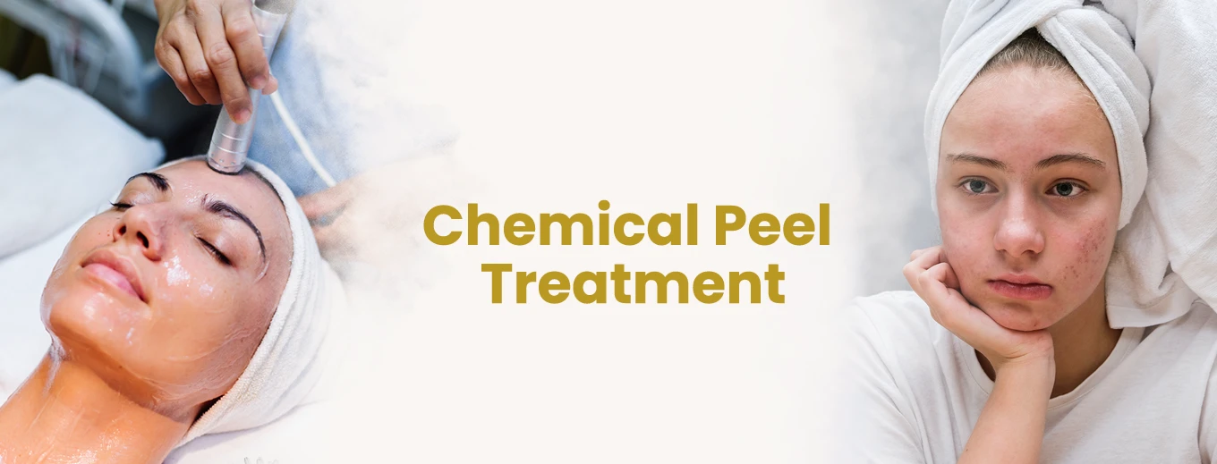 Chemical Peel2