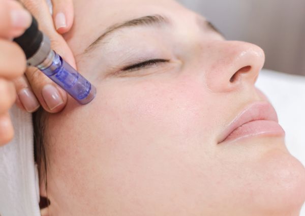 6 Fun Facts About Microneedling
