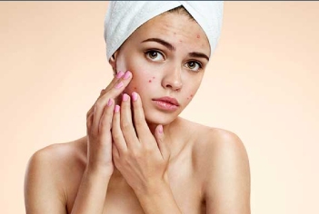 Pimple-Acne-Treatment