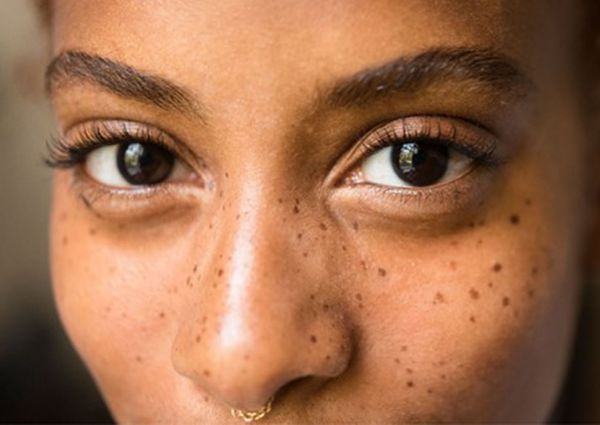How to Protect Yourself from Developing Hyperpigmentation