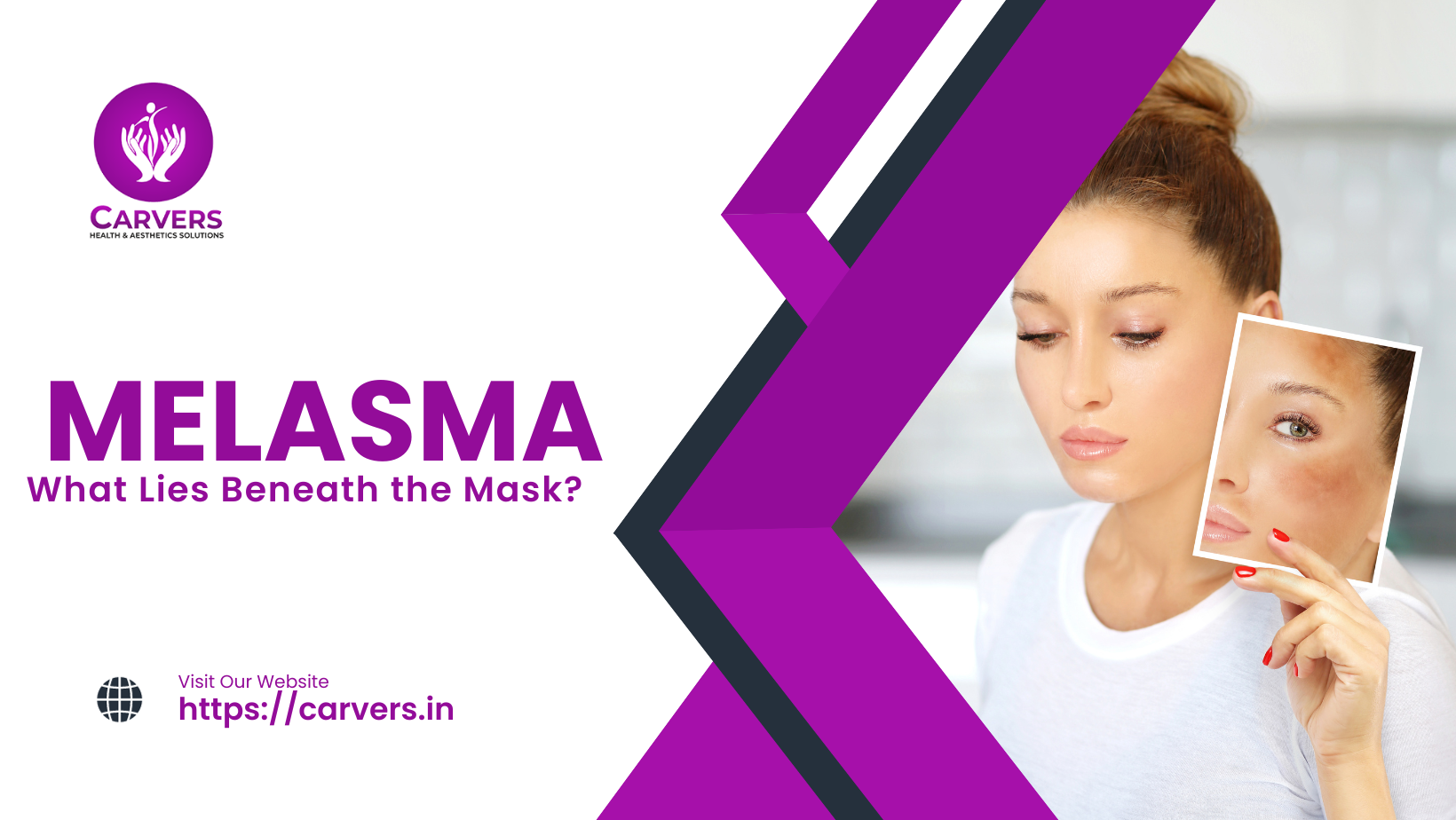 MELASMA: What Lies Beneath the Mask?
