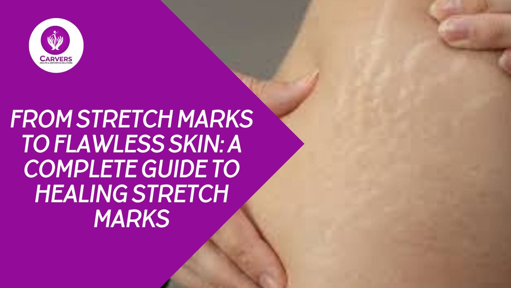 From Stretch Marks to Flawless Skin: A Complete Guide To Healing Stretch Marks