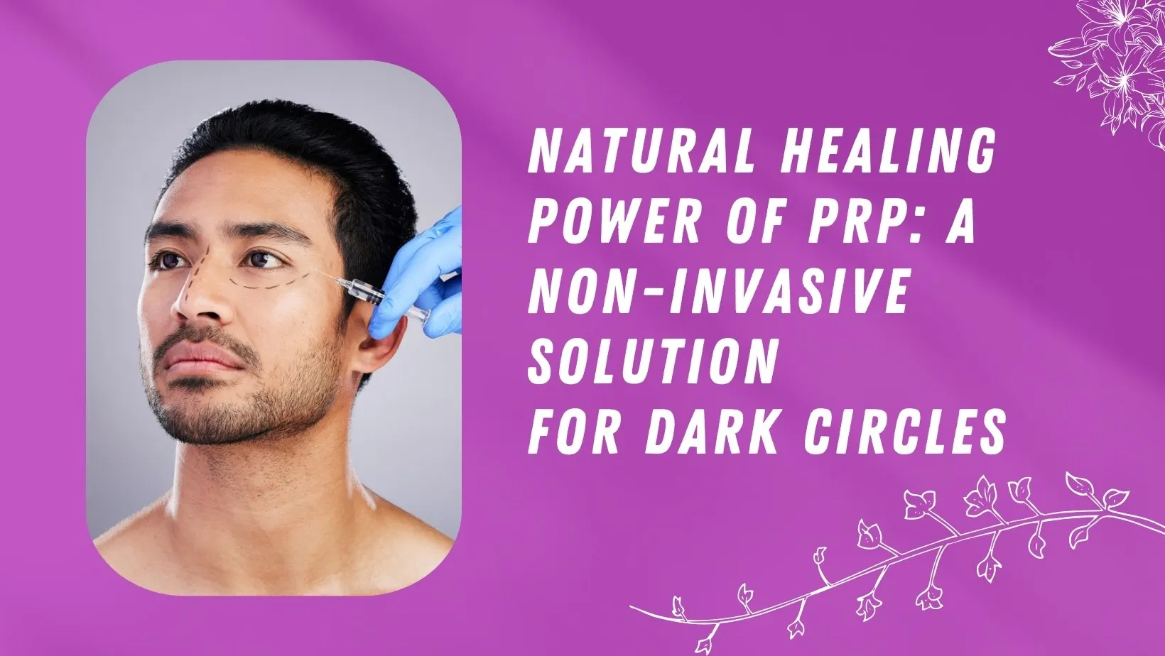 Natural Healing Power Of PRP: A Non-Invasive Solution For Dark Circles