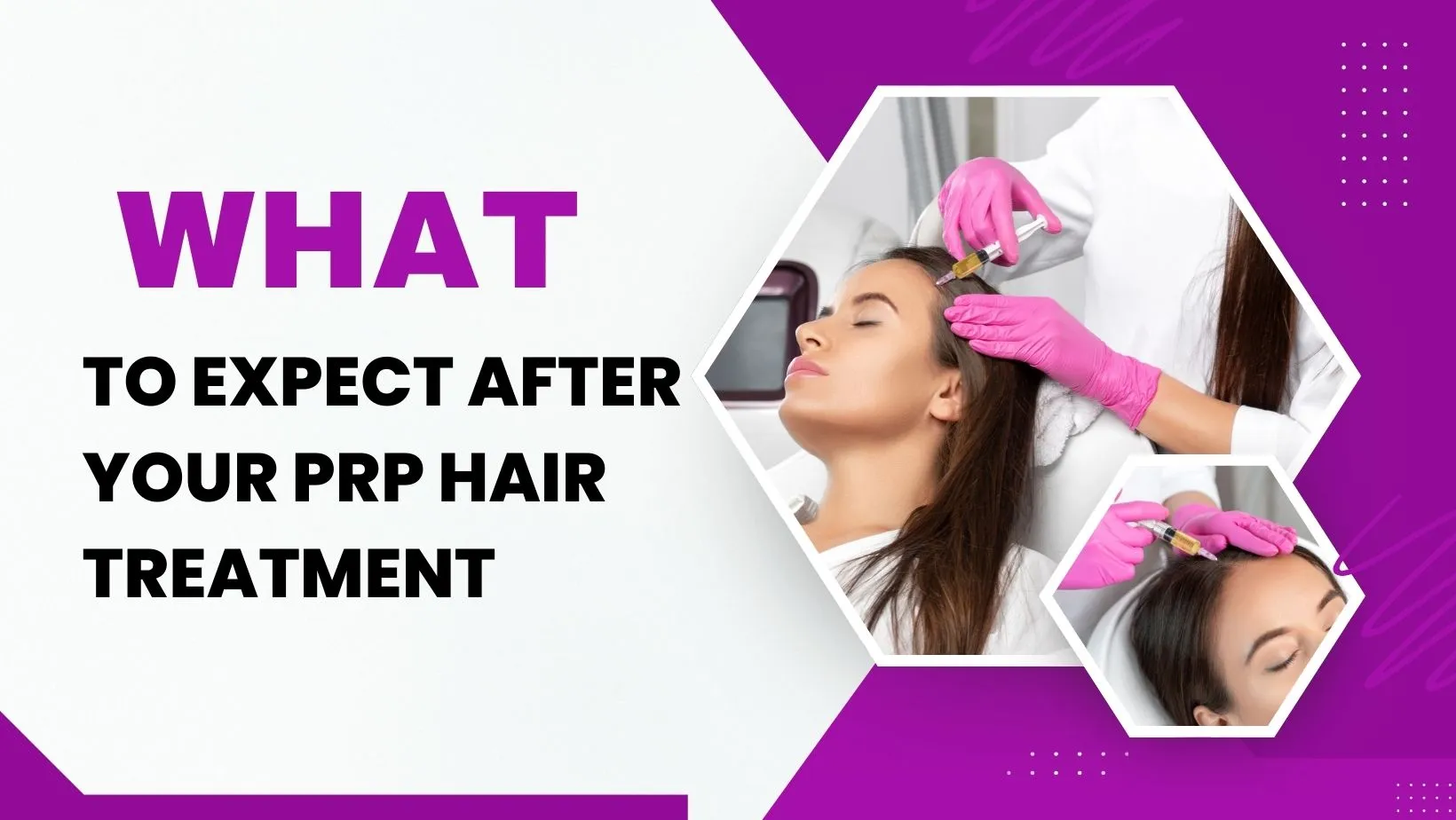 What To Expect After Your PRP Hair Treatment
