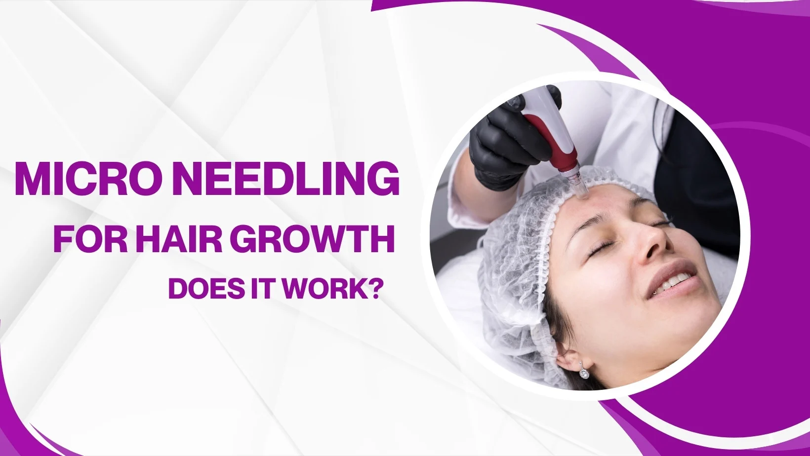 Microneedling For Hair Growth: Does It Work?