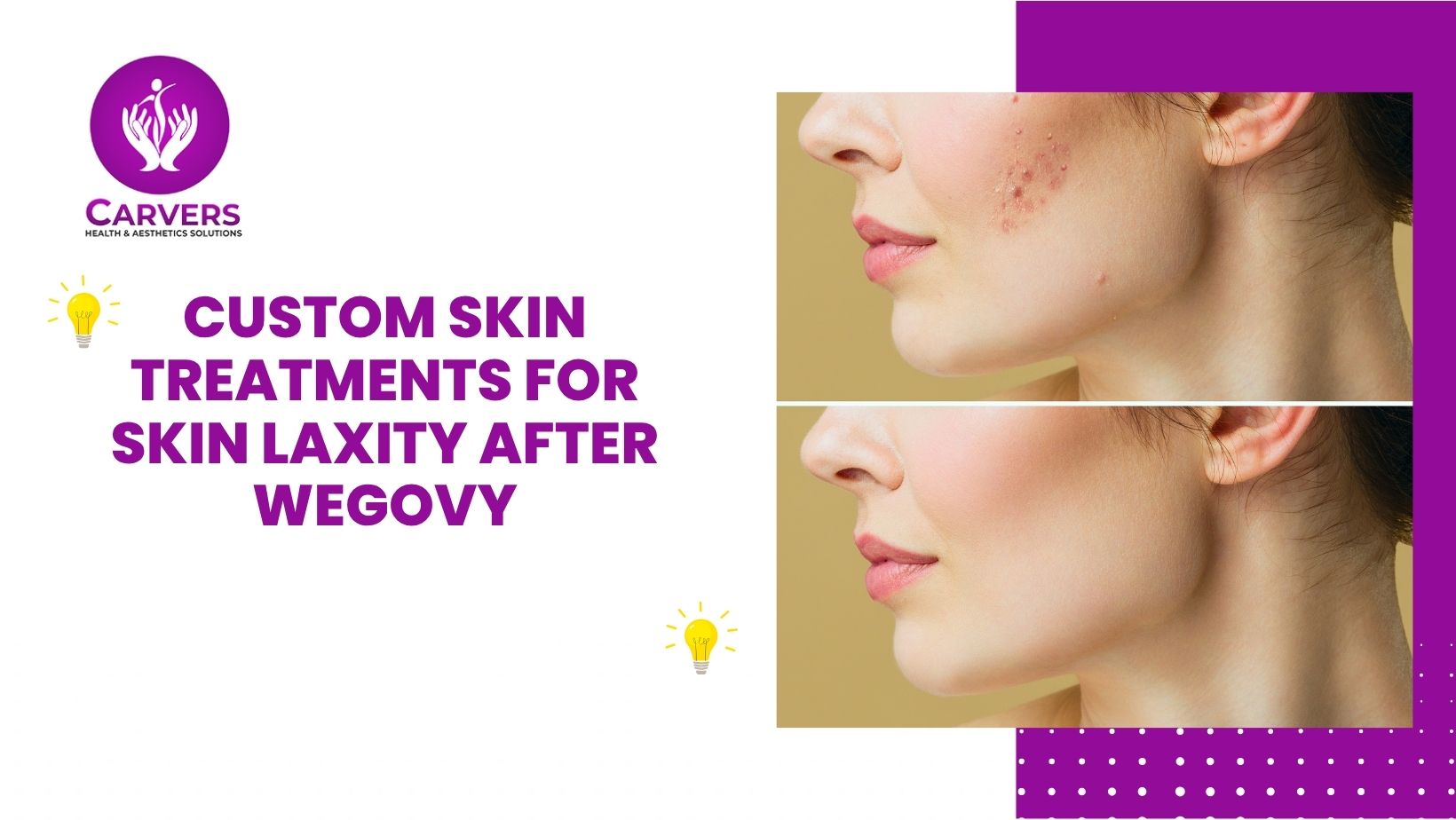 Custom Skin Treatments for Skin Laxity After Wegovy