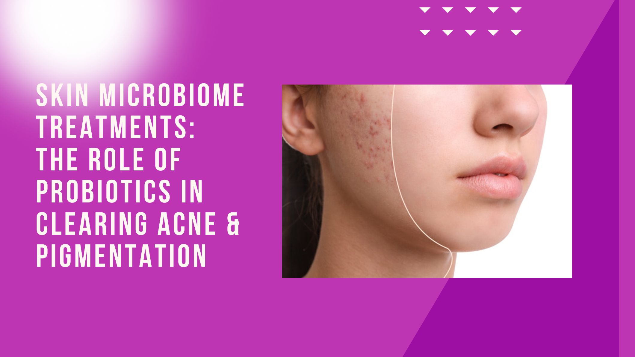 Skin Microbiome Treatments: The Role of Probiotics in Clearing Acne & Pigmentation