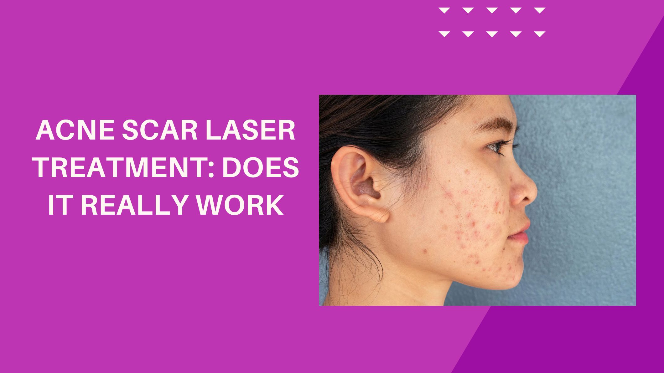 Acne Scar Laser Treatment: Does It Really Work