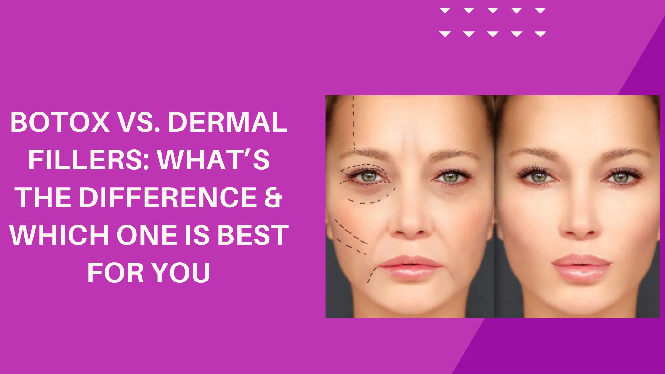 Botox vs. Dermal Fillers: What’s the Difference & Which One is Best for You