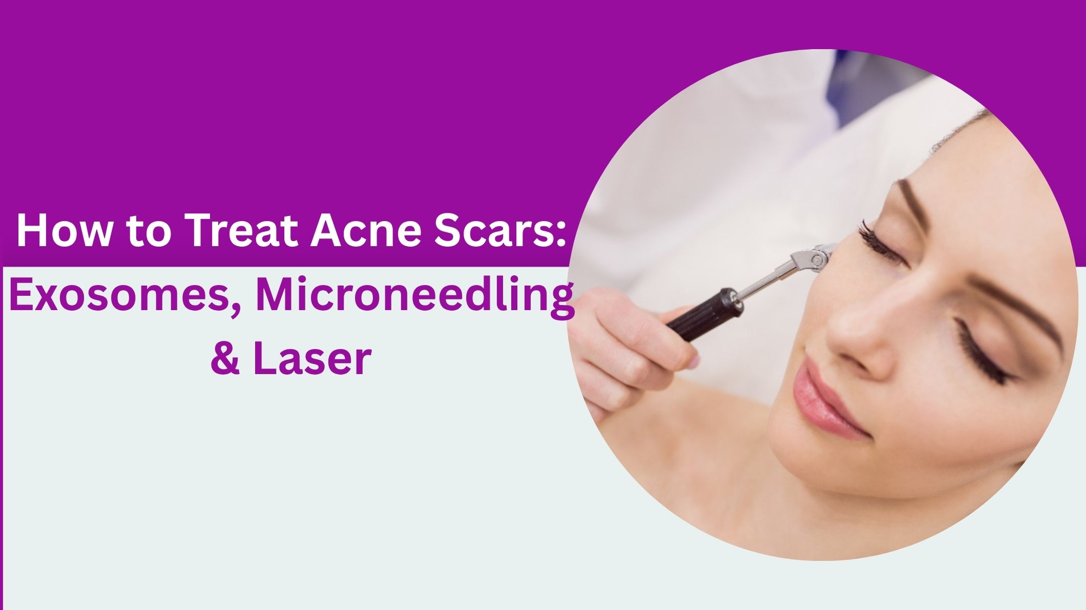 How to Treat Acne Scars: Exosomes, Microneedling & Laser
