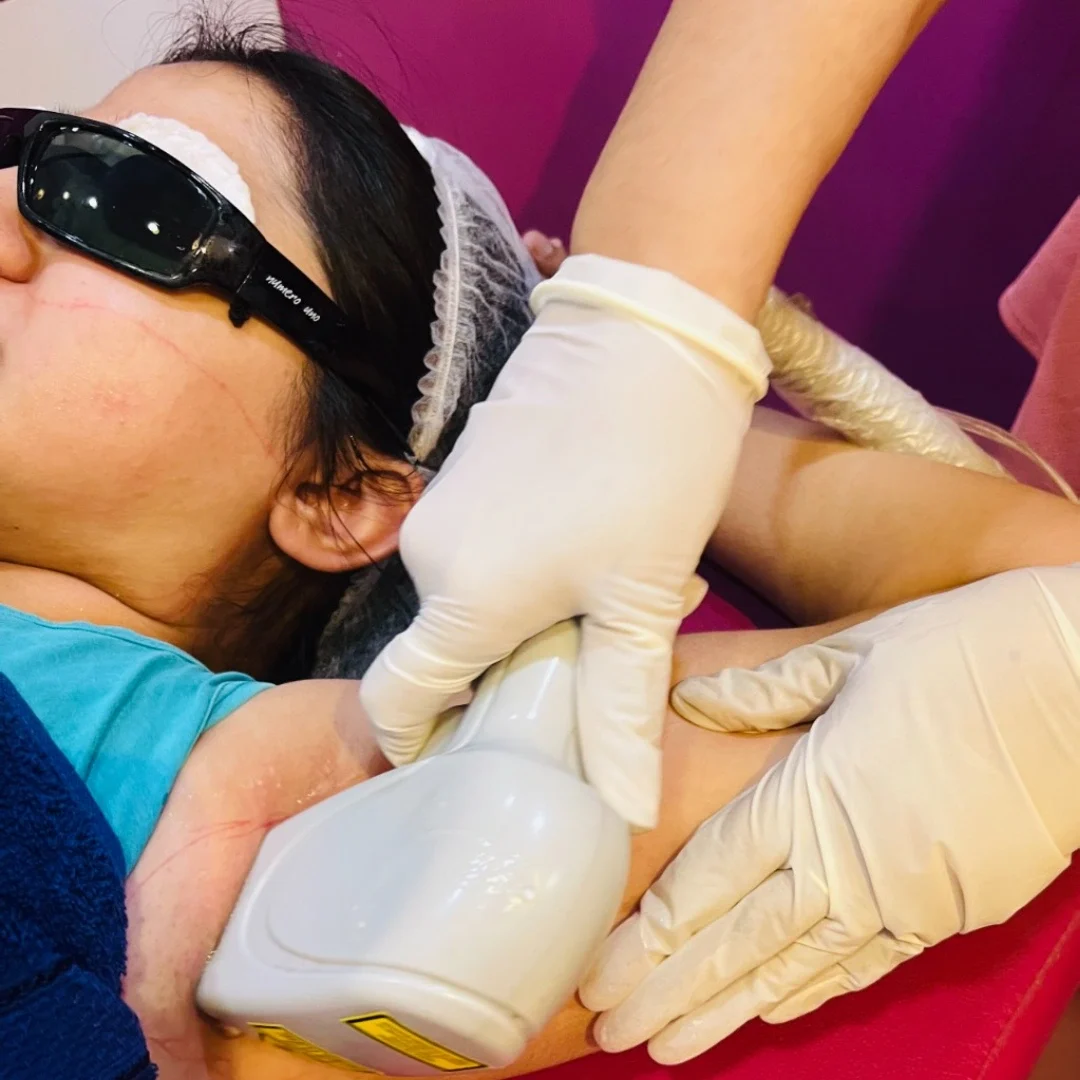 laser-hair-removal-in-delhi-ncr